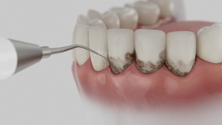 Trusted Wisdom Tooth Removal service in Gunnison, CO - Dentist Open Now